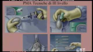 PMA  Procreazione medicalmente assistita [upl. by Eetnom265]