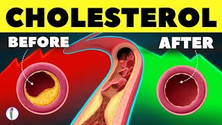 10 Natural Ways to Clear Your Artery  High Cholesterol  LDL  HDL  Heart Attack prevention tips [upl. by Doti]