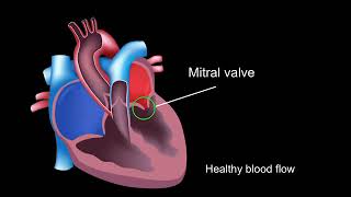 Physiology of rheumatic heart disease [upl. by Nunci99]