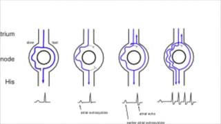 AVNRT AV nodal reentrant tachycardia [upl. by Ahsyekal]