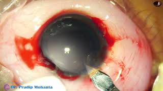 Pediatric cataract surgery Phacoaspiration IOL implantation VITRCTORHEXIS postop pictures  PM [upl. by Lacim]