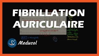 La Fibrillation Auriculaire Définition et Symptômes [upl. by Azile]