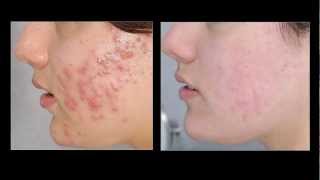 Acne Vulgaris [upl. by Sitra]