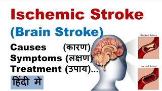 Ischemic Stroke in Hindi  Causes Symptoms Prevention Risk Factors [upl. by Ronna]