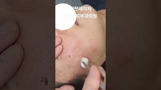 리팟 레이저 다발성 흑자 세종리팟 세종시리팟 reepot lentigo multiplelentigo 청주리팟 공주리팟 대전리팟 오창리팟 오송리팟 부여리팟 [upl. by Eeral849]