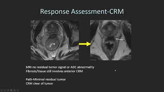 Rectal cancer imaging [upl. by Nagirrek]