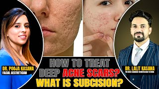 How To Treat DEEP ACNE SCARS What is SUBCISION  DrLalit Kasana  DrPooja Kasana [upl. by Nilyak]