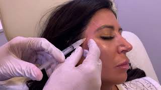 Sculptra To Fix Hollow Temples  Facial Contouring  Los Angeles [upl. by Zul]