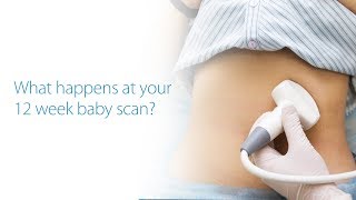 What to Expect At Your 12 Week Baby Scan Dublin Ireland [upl. by Aynos]