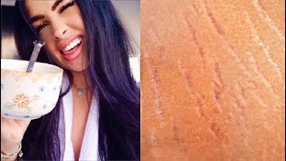 HOW TO GET RID OF STRETCH MARKS Naturally  Fast  DIY Stretch Mark Removal Serum 100 Works [upl. by Premer869]