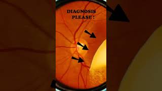 Diabetic retinopathy  Vitreous  Hard exudates  Fundus  Short Video 192 [upl. by Stephana]