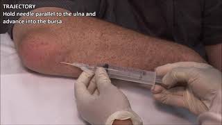 Olecranon Bursitis  Aspiration and Injection  In Vivo Series [upl. by Arateehc]