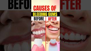 Causes Of Bleeding gums shorts [upl. by Kitarp910]