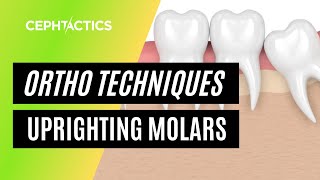 Up righting molars in Orthodontics [upl. by Methuselah]