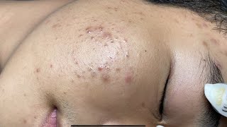 ACNE TREATMENT VU QUYNH MI Acne On Boys Chin 2024 [upl. by Lavine]