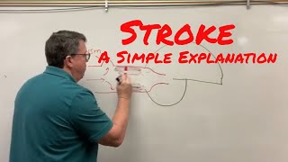 Stroke Cerebrovascular Accident A Simple Explanation [upl. by Padraig]