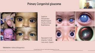 Lecture An Approach to the Juvenile Patient With Glaucoma [upl. by Eerahs945]