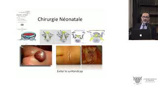 Le traitement chirurgical prénatal endoscopique du myéloméningocèle [upl. by Arytas687]