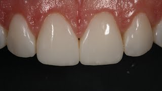 Resin Veneering and Freehand Diastema Closure [upl. by Lorien]