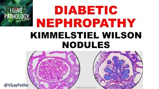 DIABETIC NEPHROPATHY Pathophysiology amp Morphology [upl. by Ada]