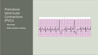 Intro to antiarrhythmics [upl. by Beret318]