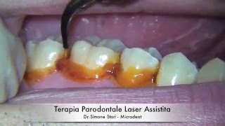 Terapia Parodontale Laser Assistita [upl. by Senecal]