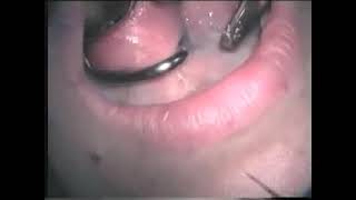 Dental laser treatment video 3 [upl. by Stevana]