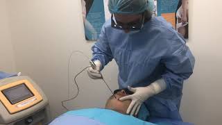 Liposuccion du double menton au laser par DR NEDRA GHARBI [upl. by Otaner]