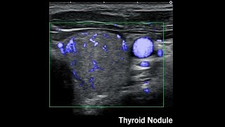 Superb MicroVascular Imaging SMI [upl. by Pennington]