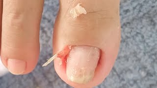 Reasons you need to clean the corners of your toenails  part 83NhaNguyenPhanThiet [upl. by Aelsel]