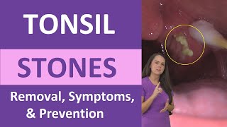 Tonsil Stones Removal Causes Symptoms Cotton Swab Treatment [upl. by Ahselaf]