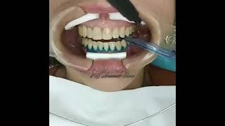 blanqueamiento dental [upl. by Cloe575]