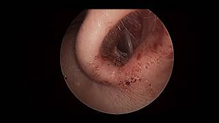 septal mucositis [upl. by Lindly982]