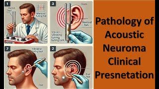 3 Pathology of Acoustic Neuroma Clinical Presnetation [upl. by Maribeth904]