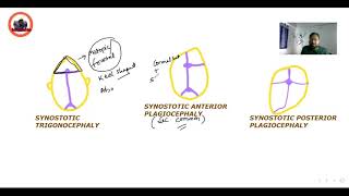 craniosynostosis scaphocephaly brachycephaly [upl. by Xer]