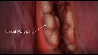 Nasal Polyps diagnosis and treatment options [upl. by Colon750]