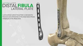 Zimed  Locking Distal Lateral Fibula Plate [upl. by Oramug69]