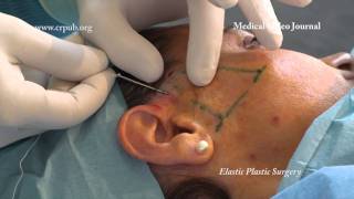 1 Elastic face lift of the cheeks without blunt dissection [upl. by Verdi]