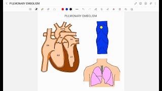 PULMONARY EMBOLISM [upl. by Suiradal]