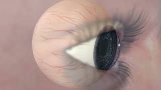 Animation Diabetic Retinopathy [upl. by Vaden54]