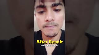 Acne Removal Before amp After skincare lasertreatment [upl. by Eelnayr]