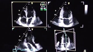 Triplane Echokardiographie triplane echocardiography [upl. by Illib909]