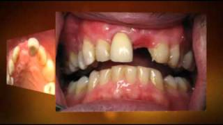 Front Dental Implant  1 hour Same Day [upl. by Sue]