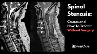 Spinal Stenosis Causes and How to Treat It Without Surgery [upl. by Misak579]