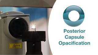 Yag Laser Capsulotomy for Posterior Capsule Opacification [upl. by Carlson639]