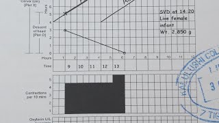 How to use a partograph step by step guide [upl. by Euqor]