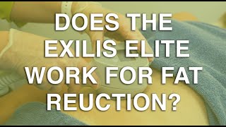 Does the Exilis Elite work for fat reduction  The Body Clinic  Exilis Elite Fat Reduction FAQ 🎯 [upl. by Latoniah953]