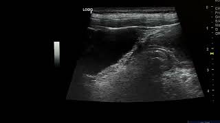 gastric outlet obstruction due to gastric cancer [upl. by Awuhsoj]