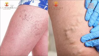 Your Healthy Family Treating spider and varicose veins [upl. by Ahsenik]