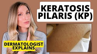 Dermatologist Explains Keratosis Pilaris KP Affordable Drugstore Treatments to Try [upl. by Chap]